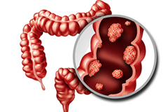 Hayat tarzınız kolon kanserine sebep olabilir