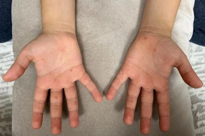 Uzmanı uyardı, bu hastalık hafife alınmamalı