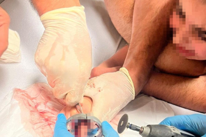 Bursa’da çocuğun parmağı çeşme aynasına sıkıştı