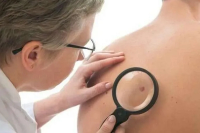 "Cilt kanserinden korunmak için güneşe karşı gerekli önlemi alın"