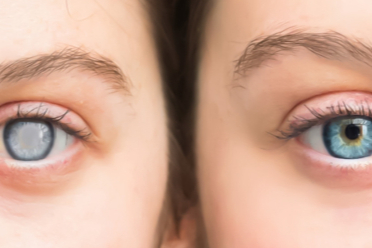 Göz doktorundan uyarı: Kataraktı önlemede beslenme etkili