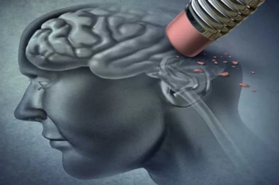 Uzmanı Alzheimer'ın belirtilerini anlattı