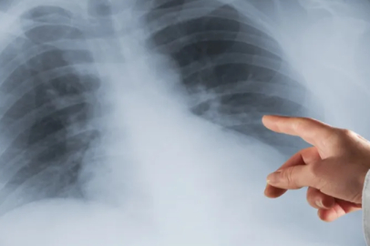 ‘‘Akciğer kanserinin Türkiye’deki ekonomik yükü 129 milyar TL’ye ulaştı’’