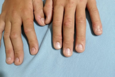 Okullar Başladı: El-Ayak-Ağız Hastalığına Dikkat!