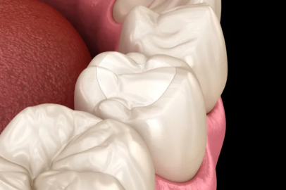 Estetik dolguların ömrünü alışkanlıklarımız belirliyor