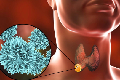 Uzmanından uyarı: "Her tiroid kanseri ameliyat gerektirmez"
